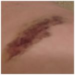 yesterday's news, today's bruise - 2025 07 22
